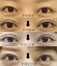 二重埋没法のダウンタイムの様子(湘南美容クリニックHPより引用)