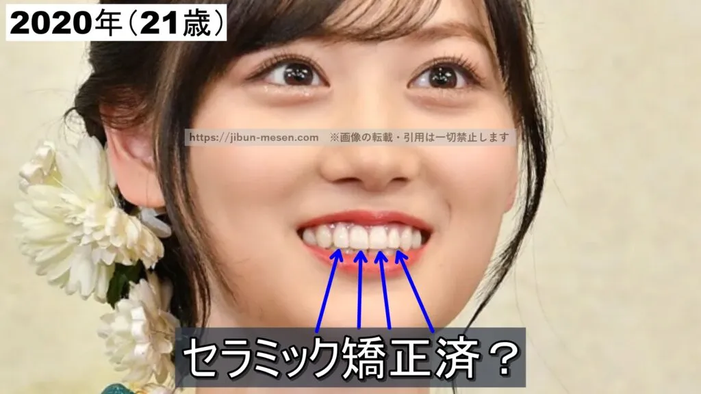 前歯をセラミック矯正した可能性が高い山下美月