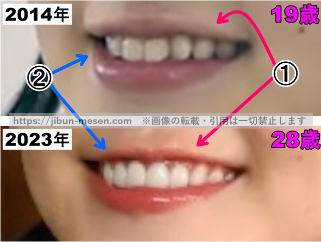 奈緒の唇の整形検証2014年〜2023年（拡大）の画像