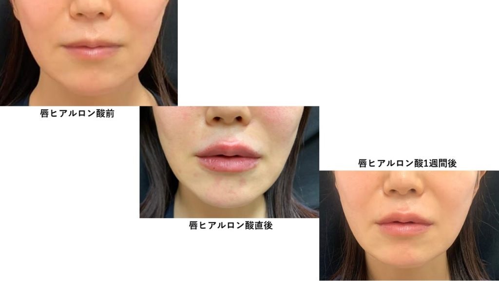 ヒアルロン酸注射による唇の整形例（アオハルクリニックHPより引用）の画像