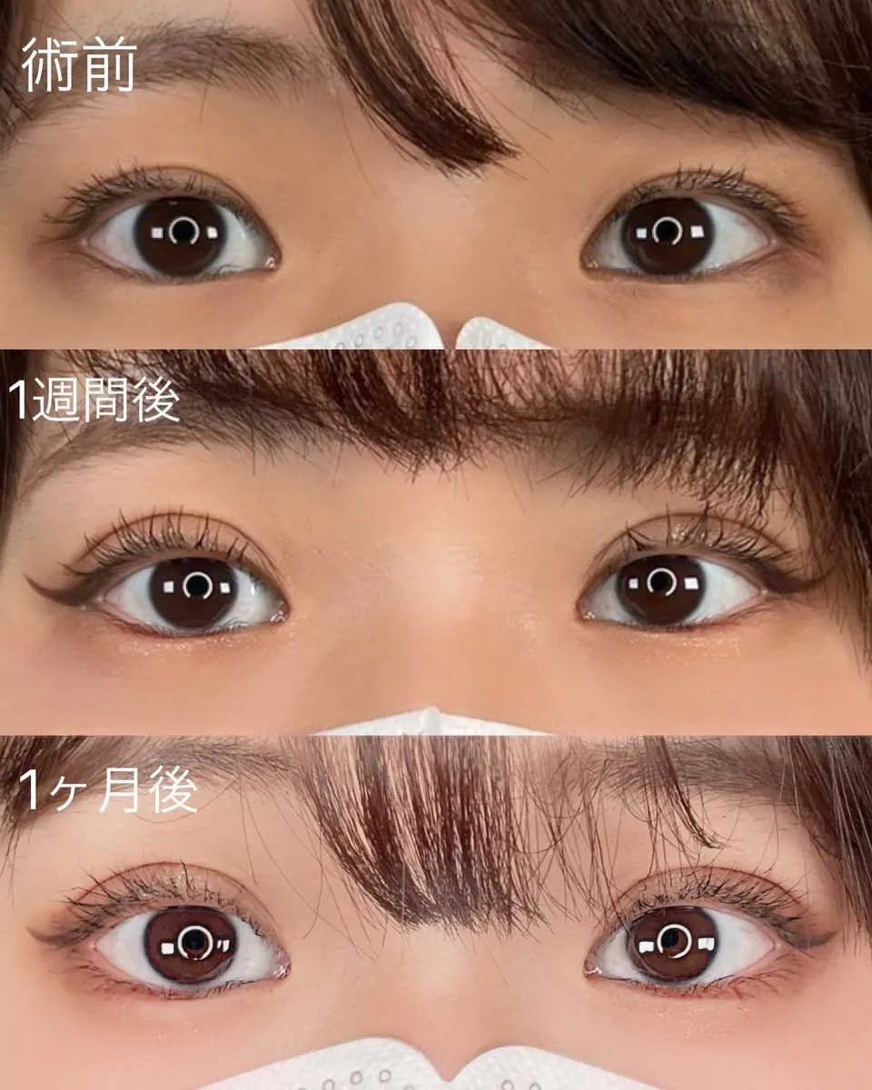 二重埋没法による目の整形例（アストラビューティクリニックHPより引用）の画像