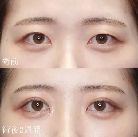 二重埋没法による目の整形例（水の森美容クリニックHPより引用）