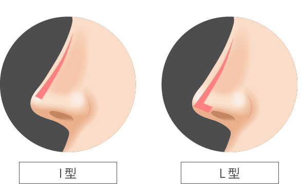 鼻に挿入するプロテーゼの種類（ガーデンクリニックHPより引用）の画像