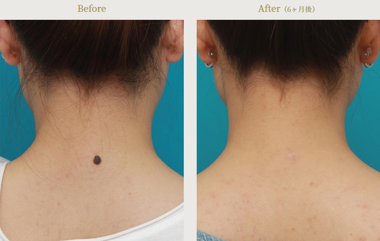 炭酸ガスレーザーによるホクロ除去の整形例（高須クリニックHPより引用）の画像