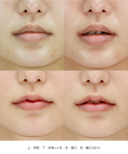 口唇縮小術による唇の整形例（牧野美容クリニックHPより引用）の画像