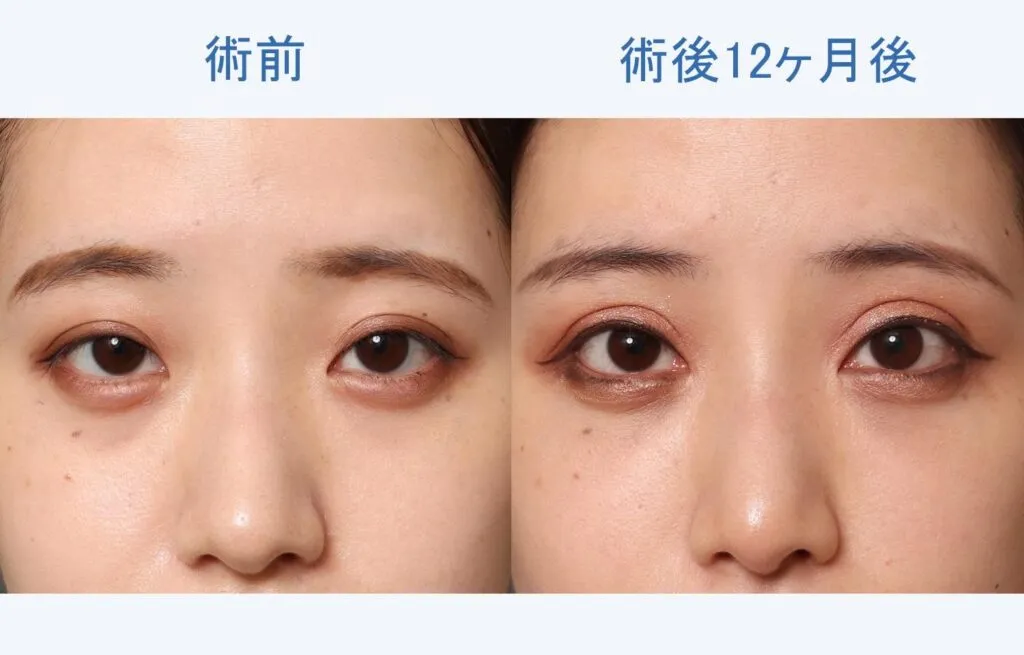 目頭切開による目の整形例（オザキクリニックHPより引用）