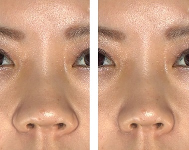 小鼻縮小術による鼻の整形例（クリニカ市ヶ谷美容外科・形成外科HPより引用）の画像
