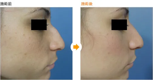 ワシ鼻修正による鼻の整形例（名古屋タワーサイドクリニックHPより引用）