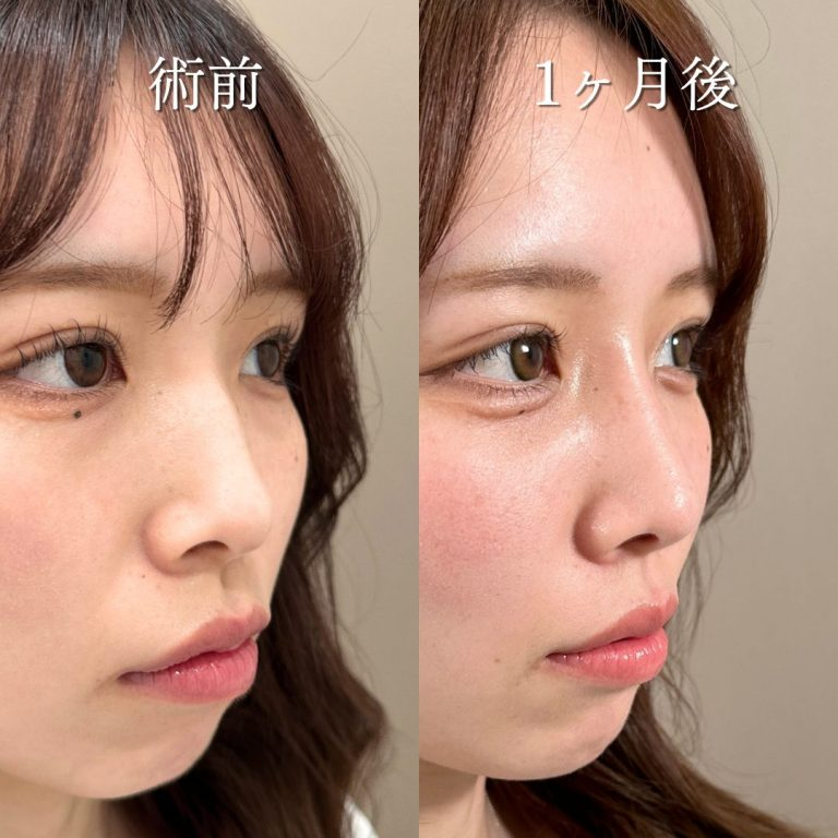 鼻プロテーゼによる鼻の整形例（東京中央美容外科HPより引用）の画像