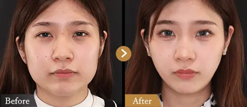 ボトックス注射によるエラの整形例(TAクリニックグループHPより引用)の画像