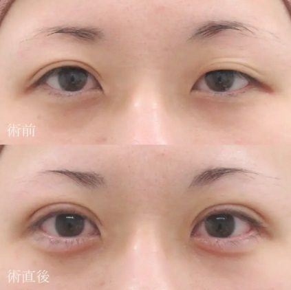 ヒアルロン酸注射による目の整形例（水の森美容クリニックHPより引用）の画像