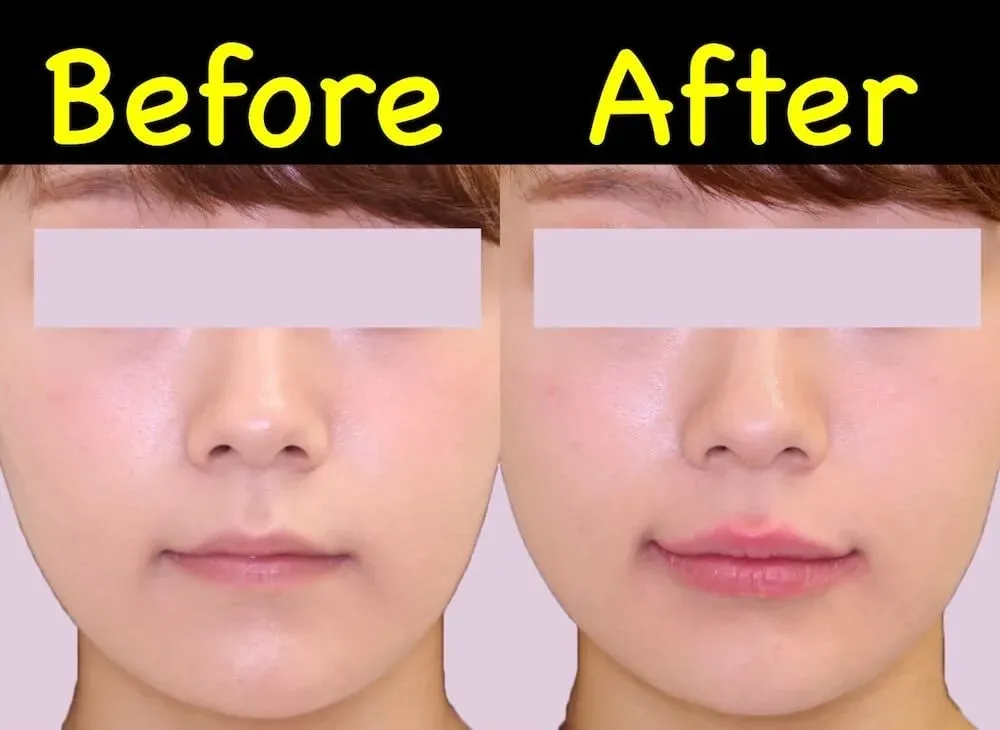 ヒアルロン酸注射による唇の整形例（銀座フェイスクリニックHPより引用）