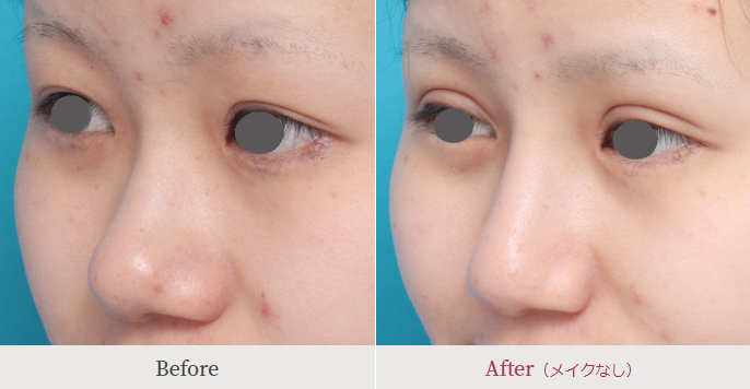 鼻尖形成術による鼻の整形例（高須クリニックHPより引用）の画像