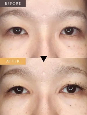 目頭切開による目の整形例（ルシアクリニックHPより引用）