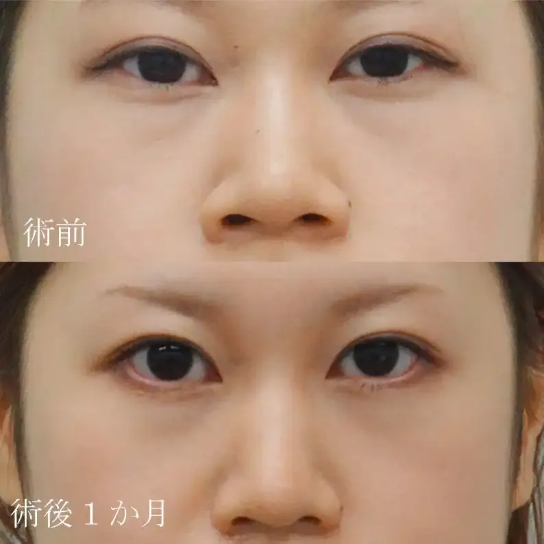 小鼻縮小術による鼻の整形例（水の森美容クリニックHPより引用）の画像