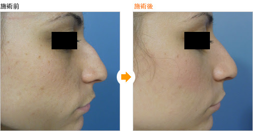 ワシ鼻修正による鼻の整形例（名古屋タワーサイドクリニックHPより引用）の画像