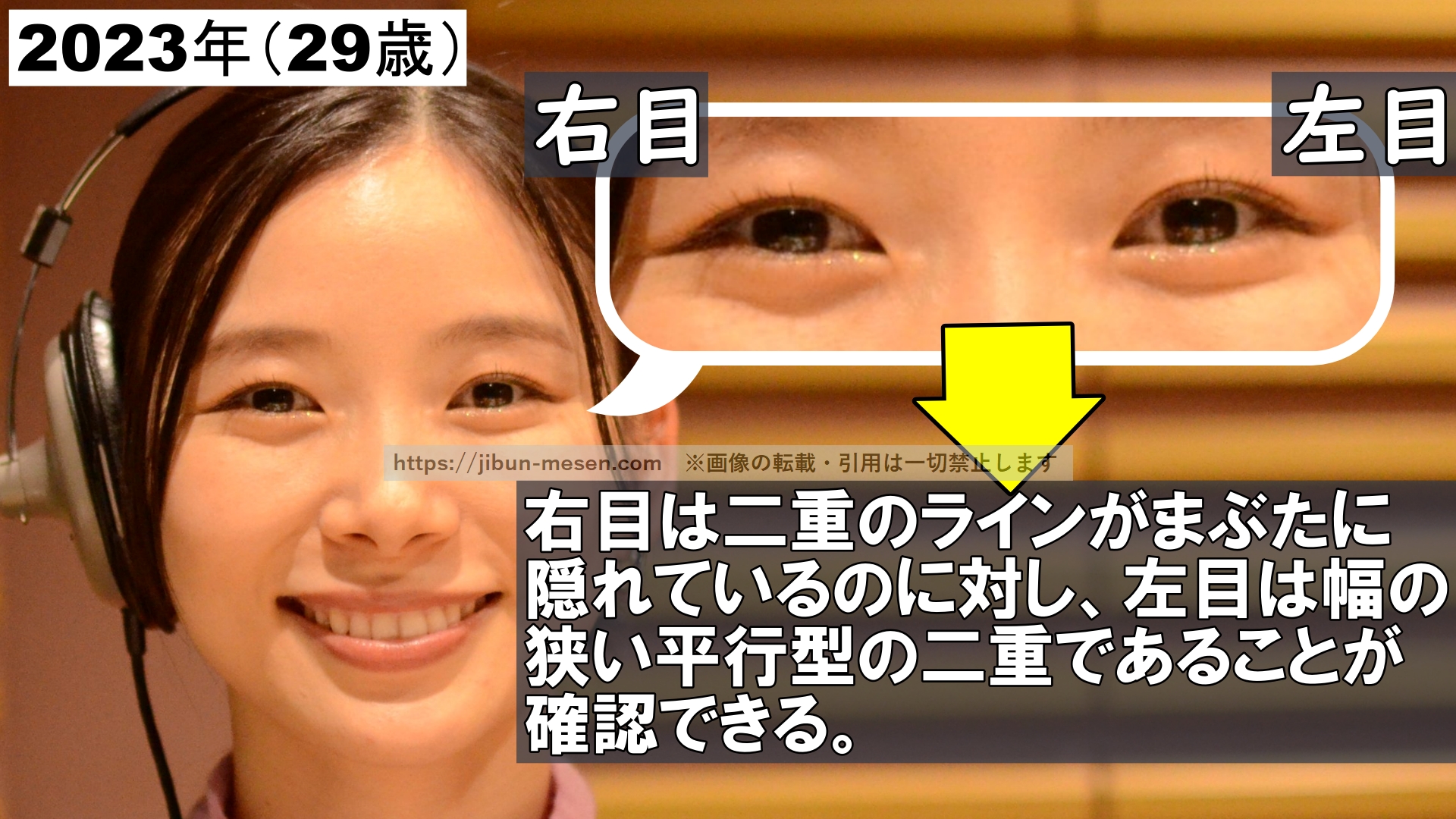 2023年(29歳)右目は二重のラインがまぶたに隠れているのに対し、左目は幅の狭い平行型の二重であることが確認できる。