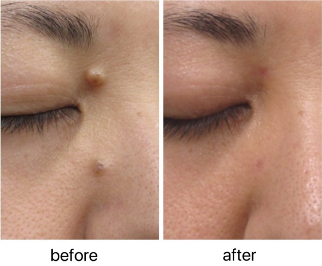 炭酸ガスレーザーによるホクロの整形例(タケダスポーツ・ビューティークリニックHPより引用)の画像