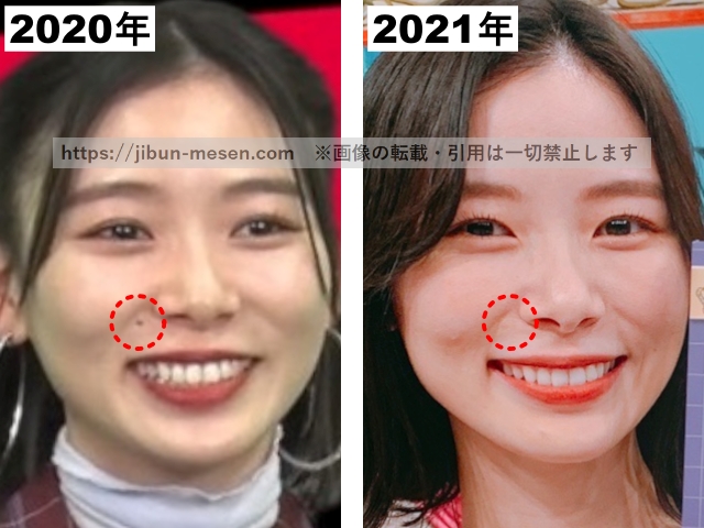 朝日奈央の整形前と整形後の比較の画像