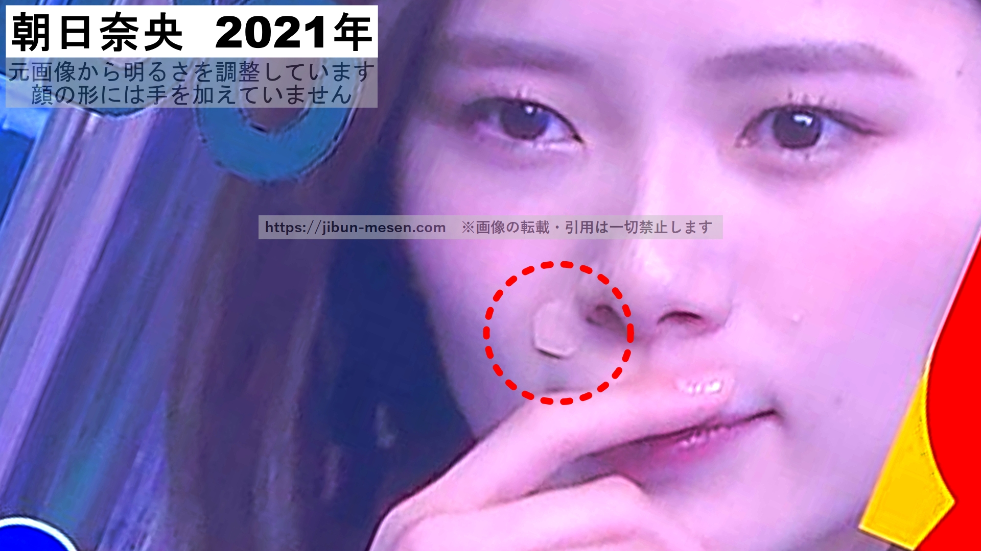 整形の手術痕をテープで隠す朝日奈央の画像