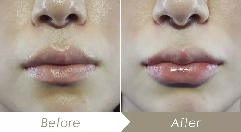 ヒアルロン酸注射による唇の整形例（プライベートスキンクリニックHPより引用）