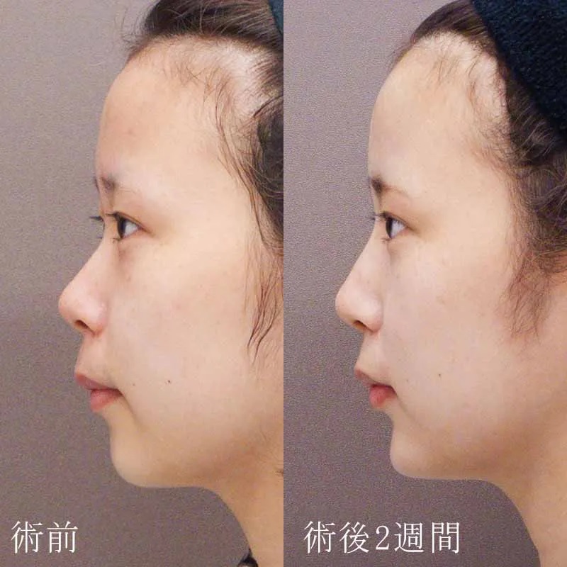 ヒアルロン酸注射による鼻の整形例（水の森美容クリニックHPより引用）の画像