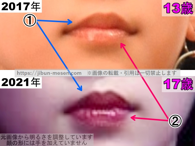 ヒカルの唇の整形検証2017年〜2021年（拡大）の画像