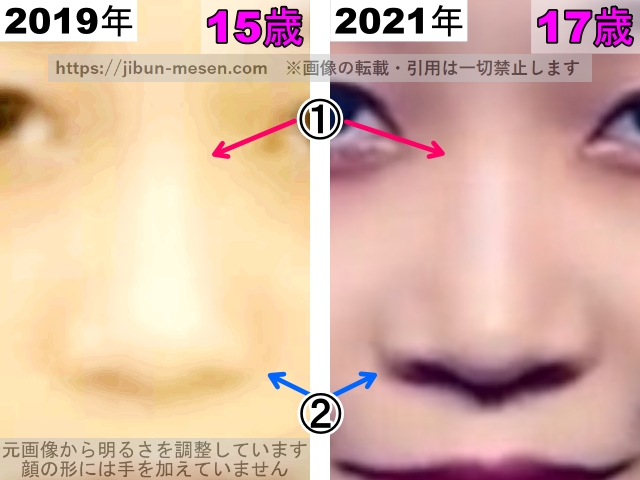 ヒカルの鼻の整形検証2019年〜2021年（拡大）の画像