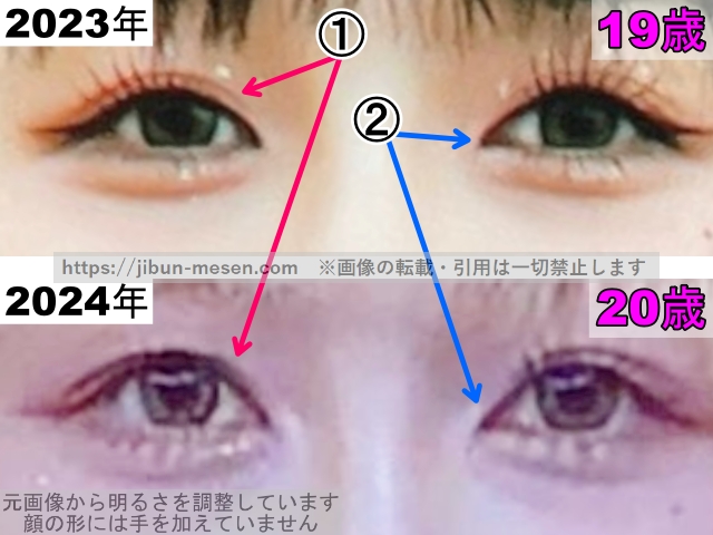 ヒカルの目の整形検証2023年〜2024年（拡大）の画像
