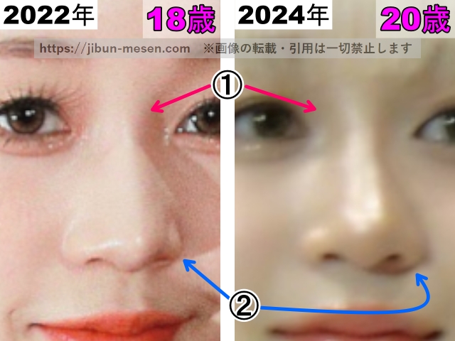 ヒカルの鼻の整形検証2022年〜2024年（拡大）の画像