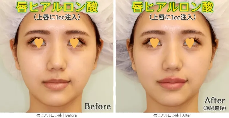 ヒアルロン酸注射による唇の整形例（銀座フェイスクリニックHPより引用）