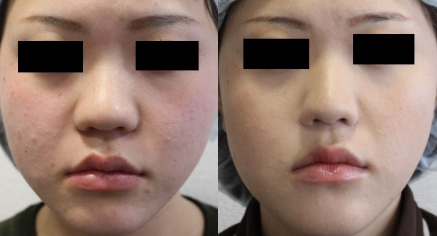 小鼻縮小術による鼻の整形例（船橋中央クリニックHPより引用）の画像