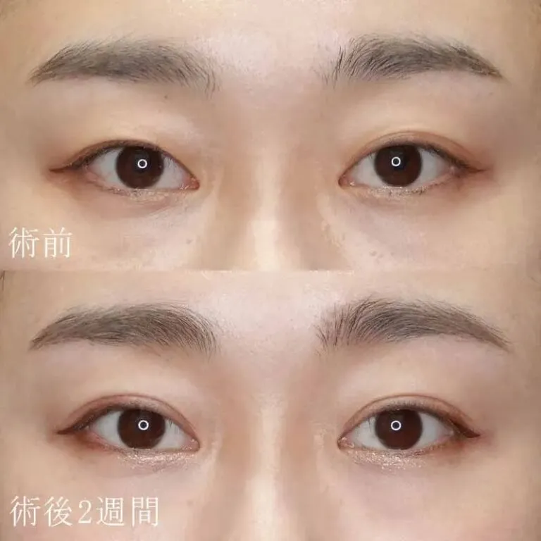 二重埋没法による目の整形例（水の森美容クリニックHPより引用）