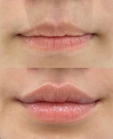 ヒアルロン酸注射による唇の整形例（クララ美容皮膚科HPより引用）の画像