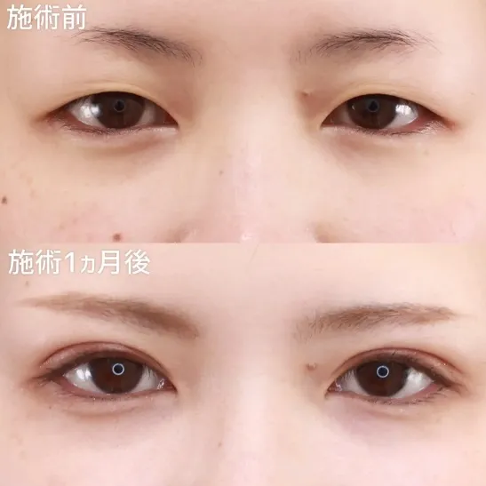 二重切開法による目の整形例（TAクリニックグループHPより引用）