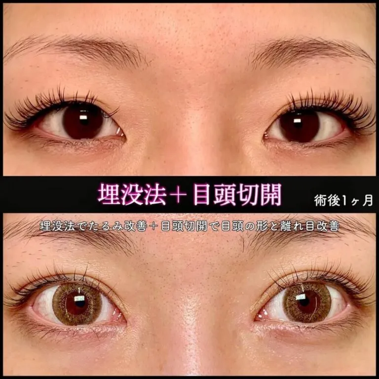 目頭切開による目の整形例（eクリニックHPより引用）