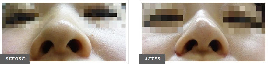 小鼻縮小ボトックス注射による鼻の整形例（東京中央美容外科HPより引用）の画像