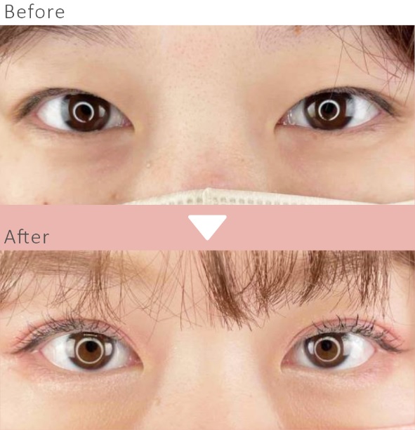 二重埋没法による目の整形例(ルラ美容クリニックHPより引用)の画像