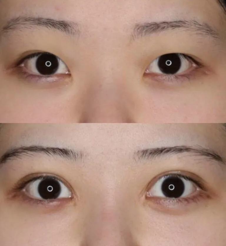 目尻切開による目の整形例(セレクトクリニックHPより引用)