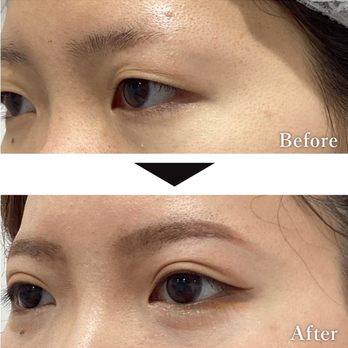 二重埋没法による目のの整形例(いとうらんクリニックHPより引用)の画像