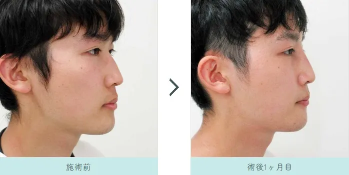 鼻プロテーゼによる鼻の整形例（水の森美容クリニックHPより引用）