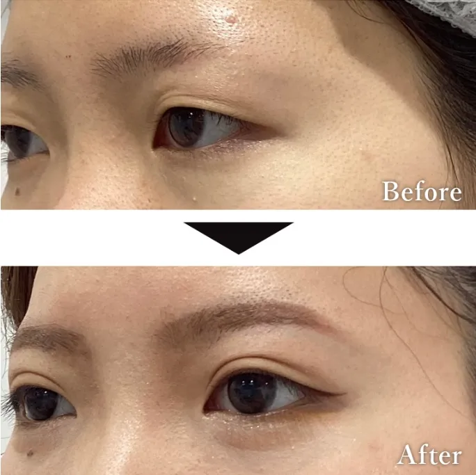 二重埋没法による目の整形例(いとうらんクリニックHPより引用)