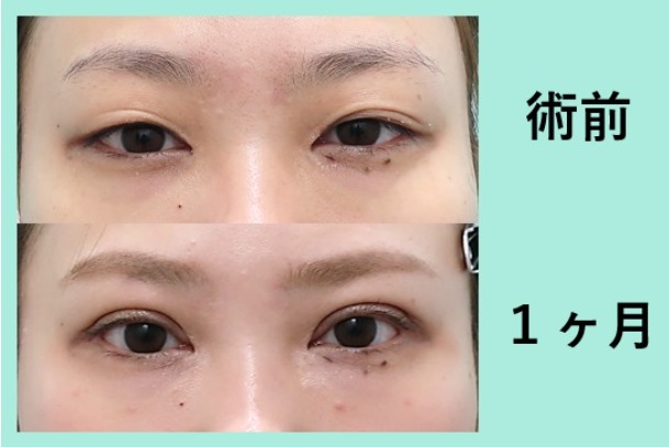 二重切開法による目の整形例(WOMクリニック銀座HPより引用)の画像
