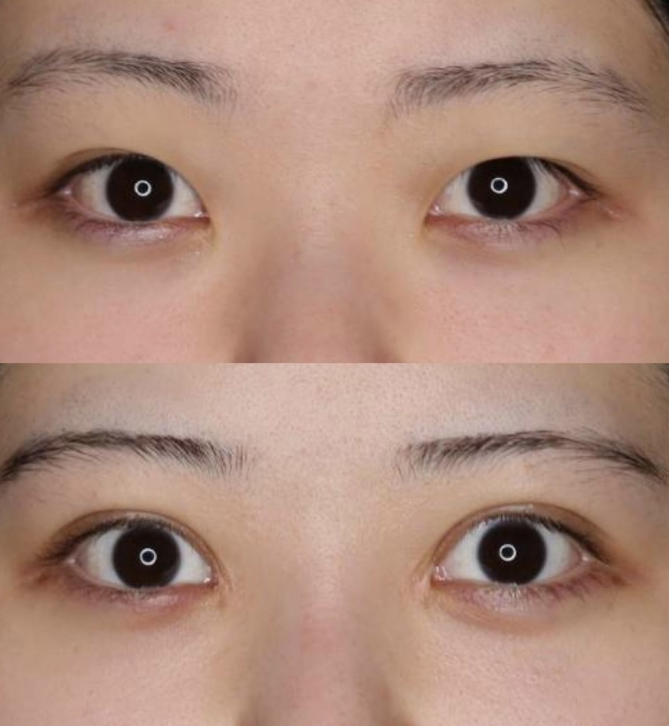 目尻切開による目の整形例（セレクトクリニックHPより引用）の画像