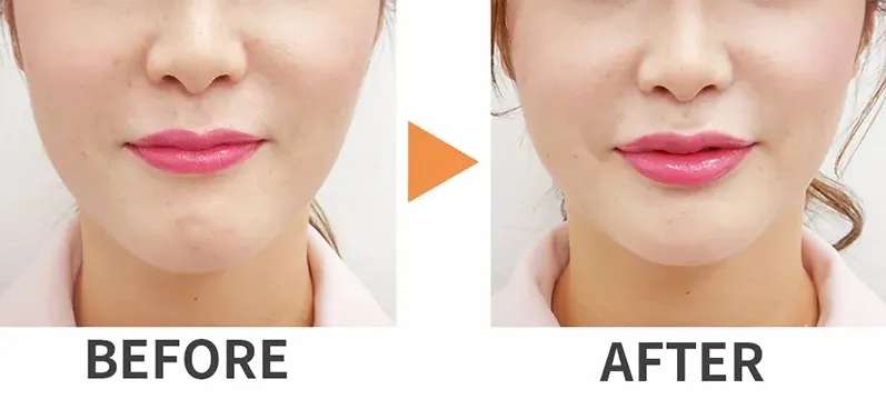 ヒアルロン酸注射による唇の整形例（水の森美容クリニックHPより引用）