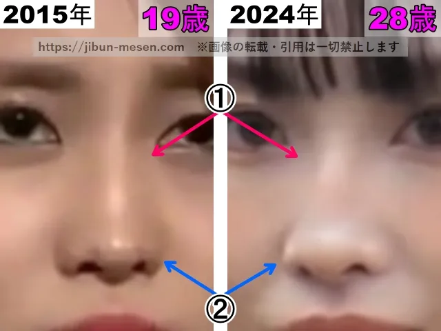 TWICEモモの鼻の整形検証2015年〜2024年（拡大）