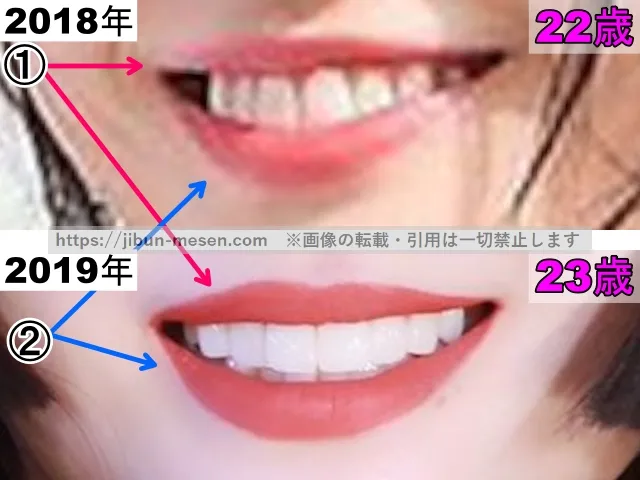 TWICEモモの唇の整形検証2018年〜2019年（開口・拡大）