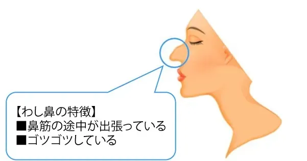 わし鼻の特徴（水の森美容クリニックHPより引用）