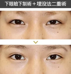 下眼瞼下制法と二重埋没法による目の整形例(新宿ラクル美容外科クリニックHPより引用)