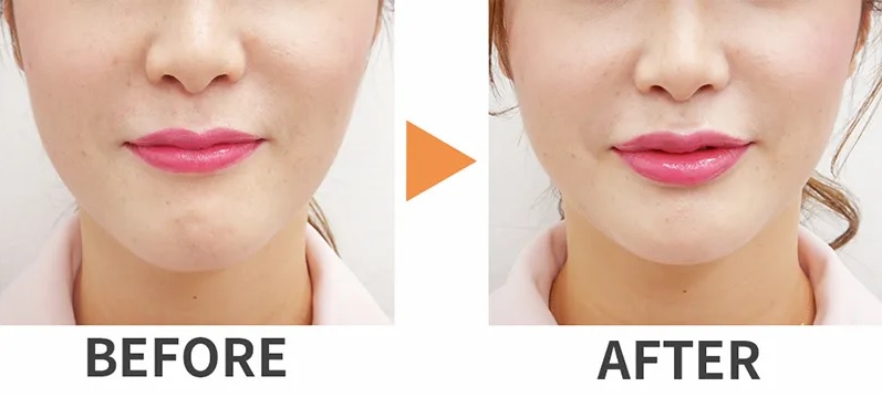 ヒアルロン酸注射による唇の整形例(水の森美容クリニックHPより引用)の画像